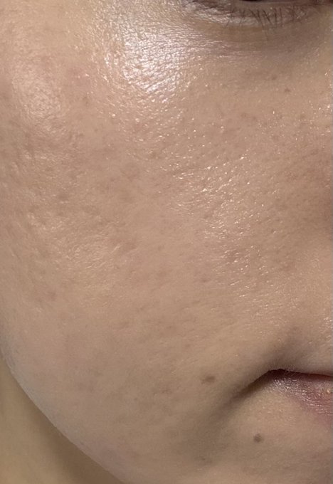 帰国前に駆け込みました 釜山デイビューで肌管理が想像以上によかったです