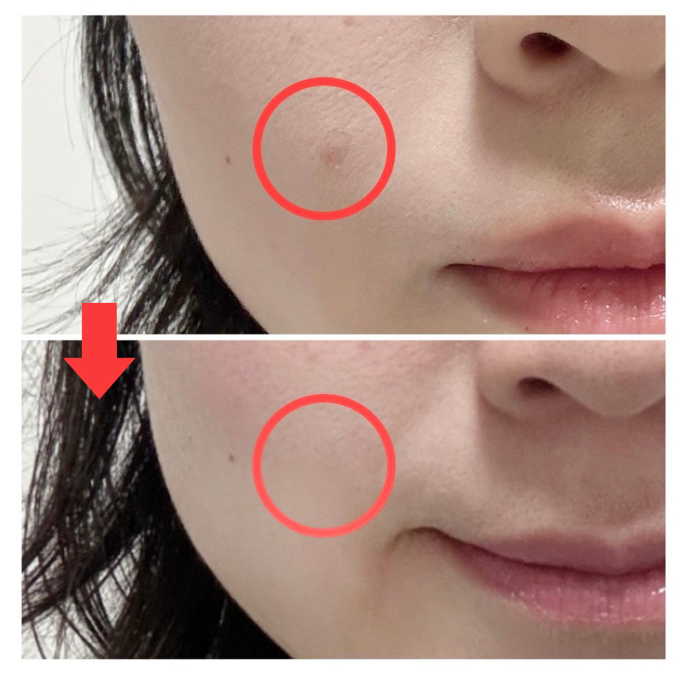 繰り返すニキビに変化？P.CALMのスポットクリームが話題